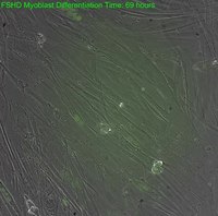 File:Timelapse Expression of DUX4 Protein in FSHD Cells.ogv