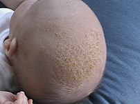 An infant with Cradle Cap