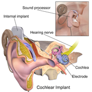 cochlear implant