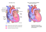 Miniatura para Miocardiopatía de takotsubo