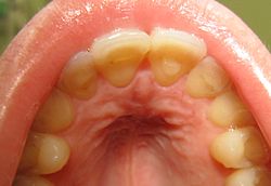 فقدان مينا الأسنان من داخل الأسنان العلوية الأمامية نتيجة للنهام العصبي