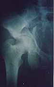 X-ray of T shape fracture