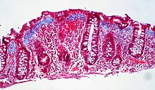 Collagenous colitis (4 of 4).jpg