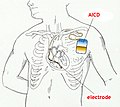 Miniatura para Desfibrilador subcutáneo