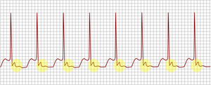 AV nodální reentrantní tachykardie.png