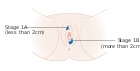 Diagram showing stage 1A and 1B cancer of the vulva CRUK 195.svg