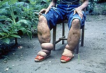 Elephantiasis.jpg