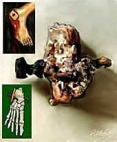 Skeletal remains of Jehohanan, 1st-century CE crucifixion victim from Givat HaMivtar in Jerusalem, with a nail still lodged inside the heel bone Hombre de Giv'at ha-Mivtar..jpg