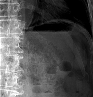 Upright AP radiograph showing gas in the wall of the small bowel in the left upper quadrant indicative of pneumatosis intestinalis.