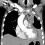 Miniatura para Mesotelioma