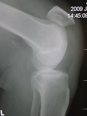 English: Patellar tendon rupture showing a mar...