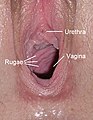 Blick in das vordere Drittel der Vagina, mit typischen Querfalten (Rugae vaginales); oberhalb die Harnröhrenmündung (Carina urethralis vaginae)