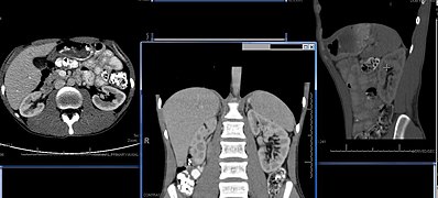 A CT scan of the abdomen showing the position of the kidneys. The left cross-section in the upper abdomen shows the liver on the left side of scan (right side of body). Center: cross-section showing the kidneys below the liver and spleen. Right: further cross-section through the left kidney.