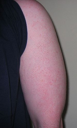 KeratosisPilaris