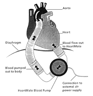 English: Graphic presentation of an LVAD, left...