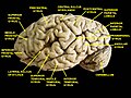 Cerebrum. Lateral view.Deep dissection.