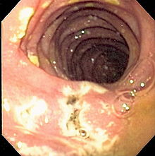 Zollinger-Ellison syndrome