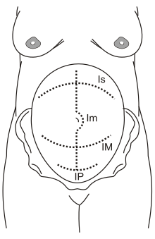 Several caesarean sections
Is: supra-umbilical incision
Im: median incision
IM: Maylard incision
IP: Pfannenstiel incision Cesareo.svg