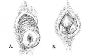 Full thickness rectal prolapse & mucosal prolapse..jpg