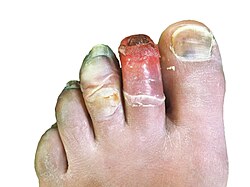 Human toes, 12 days post-frostbite