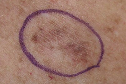 Malignant Melanoma in situ, right upper medial back, marked for biopsy (Original Post: Shared in Melanoma)