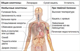 Симптомы коронавирусной инфекции (COVID-19)