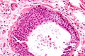 显微镜下的瓦耳塔德细胞巢（英语：Walthard cell nest），它是产生布伦内罗氏瘤的位置