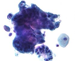 صورة مجهرية لسرطانة غدية تظهر فجوات تحتوي على الميوسين. لطاخة بابانيكولاو