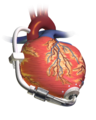 LVAD