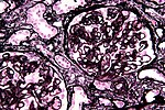 Miniatura para Glomerulonefritis membranosa