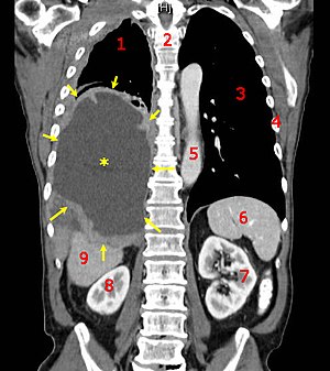 CT scan of a patient with mesothelioma, coronal section (the section follows the plane the divides the body in a front and a back half). The mesothelioma is indicated by yellow arrows, the central pleural effusion (fluid collection) is marked with a yellow star. Red numbers: (1) right lung, (2) spine, (3) left lung, (4) ribs, (5) descending part of the aorta, (6) spleen, (7) left kidney, (8) right kidney, (9) liver.