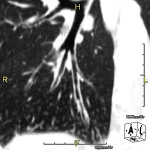 Saggital reformatted CT image showing thickene...