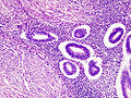 Adenomyosis uteri im mikroskopischen Bild