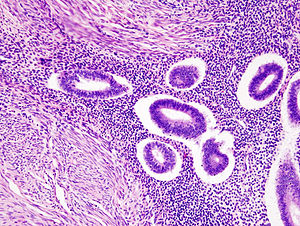 Uterine adenomyosis (1)