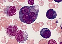 A bone marrow smear from a case of erythroleukemia. The large cell in the top center is an abnormal erythroblast: it is multinucleated, with megaloblastoid nuclear chromatin. This is diagnostic of erythroleukemia. AML-M6, multinucleated erythroblast.jpg