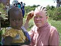 Albino girl with sister - pretty illustrative, but the pictures in article are already too Africa-centric - image needs renaming