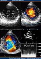 Transthoracic two-dimensional study with color and continuous wave Doppler shows left ventricular noncompaction associated with patent ductus arteriosus (PDA). [2]
