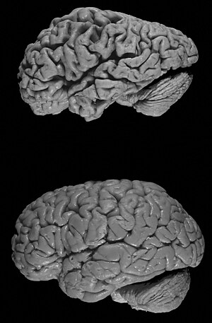 Healthy brain (bottom) versus brain of a donor...