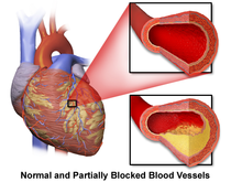 Normal vs blocked coronary artery Coronary Artery Disease.png
