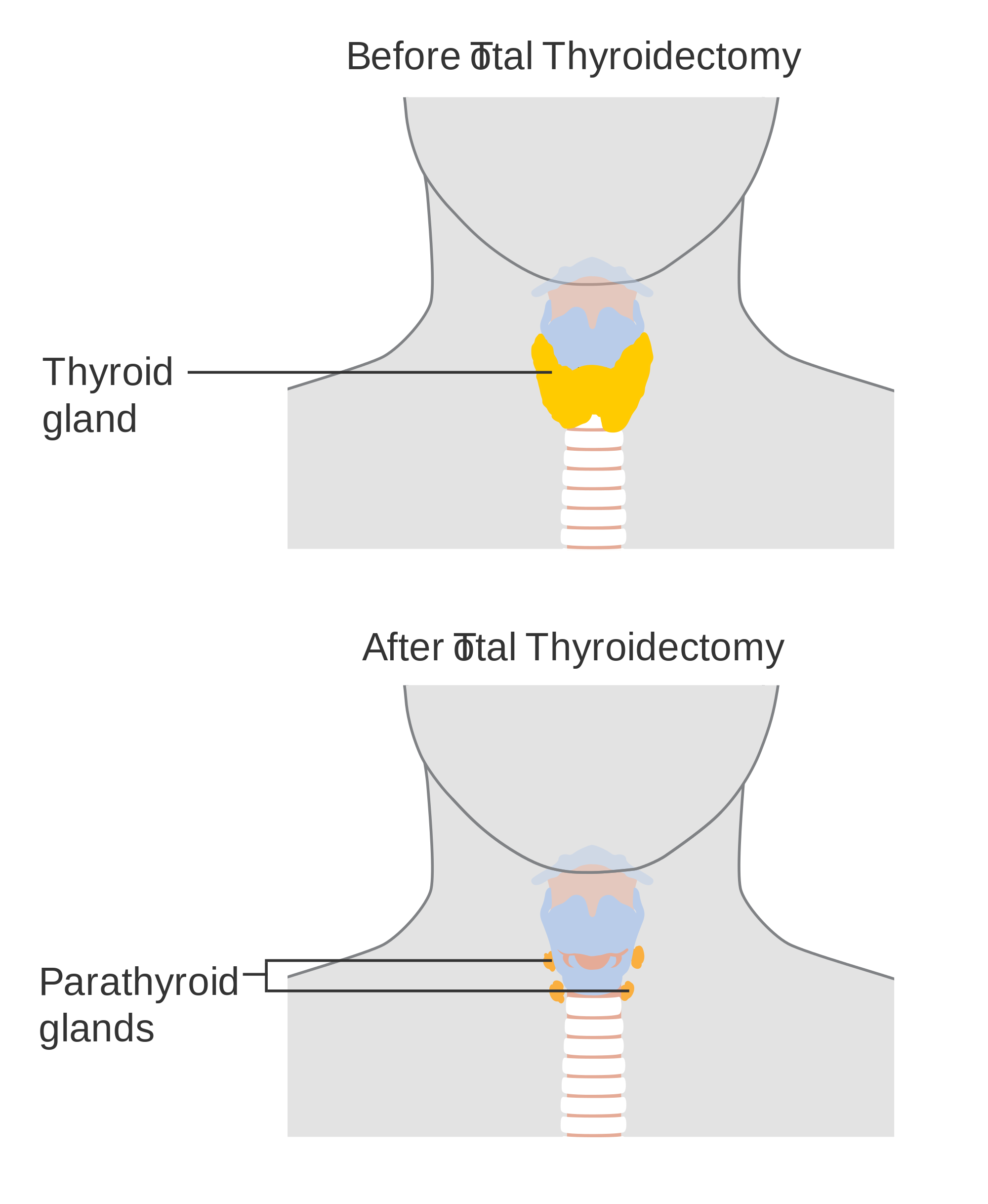 thyroidectomy and weight loss thyroidectomy