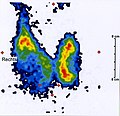 Szintigraphie eines kalten Knoten rechts