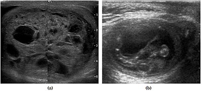 Fig. 6. Mature cystic teratoma. (a) Composite Image. Mature cystic teratoma in a 29-year-old man. Longitudinal sonography image of the right testis shows a multilocular cystic mass. (b) Mature cystic teratoma in a 6-year-old boy. Longitudinal sonography of the right testis shows a cystic mass containing calcification with no obvious acoustic shadow.[citation needed]