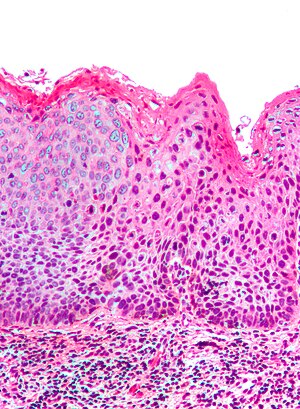 Vulvar intraepithelial neoplasia3 1.jpg