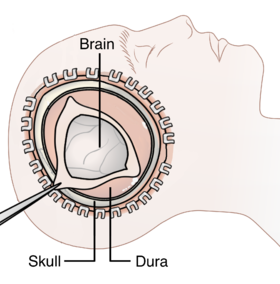 Decompressive Craniectomy.png