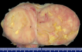 Gross pathology of an atypical solitary fibrous tumor, evidenced by some deeply yellow necrotic areas