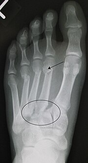 Miniatura para Lesión de Lisfranc