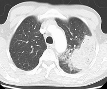 Cavitating pneumonia due to MRSA as seen on a CT scan MRSAPneumoCT.png