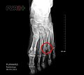 Miniatura para Neuroma de Morton