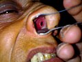 Miniatura para Perforación del septo nasal