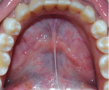 Floor of the mouth with lingual frenum and sublingual fold Floor of the mouth.png